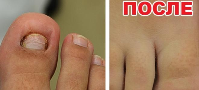 Протезирование ногтей на ногах при грибке